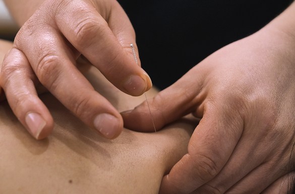 Close up of therapeutic dry needling on trigger points.