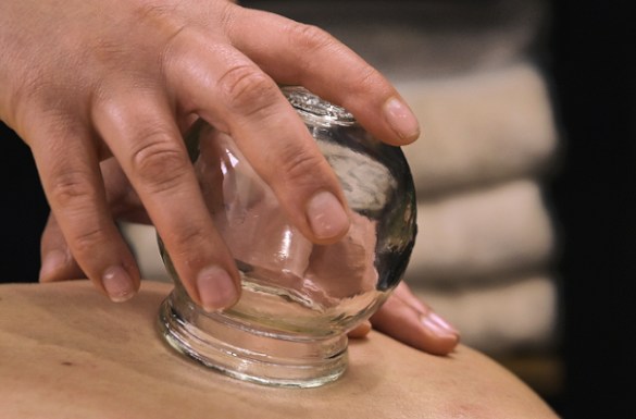 Osteopathic cupping performed in Coburg, Victoria.